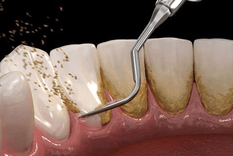 Scaling and Polishing treatment