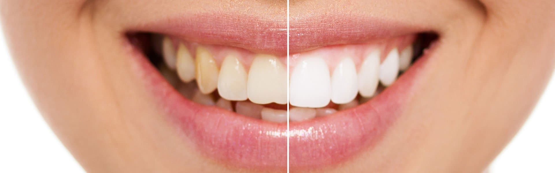 Whitening treatment at Yes Dental Clinic
