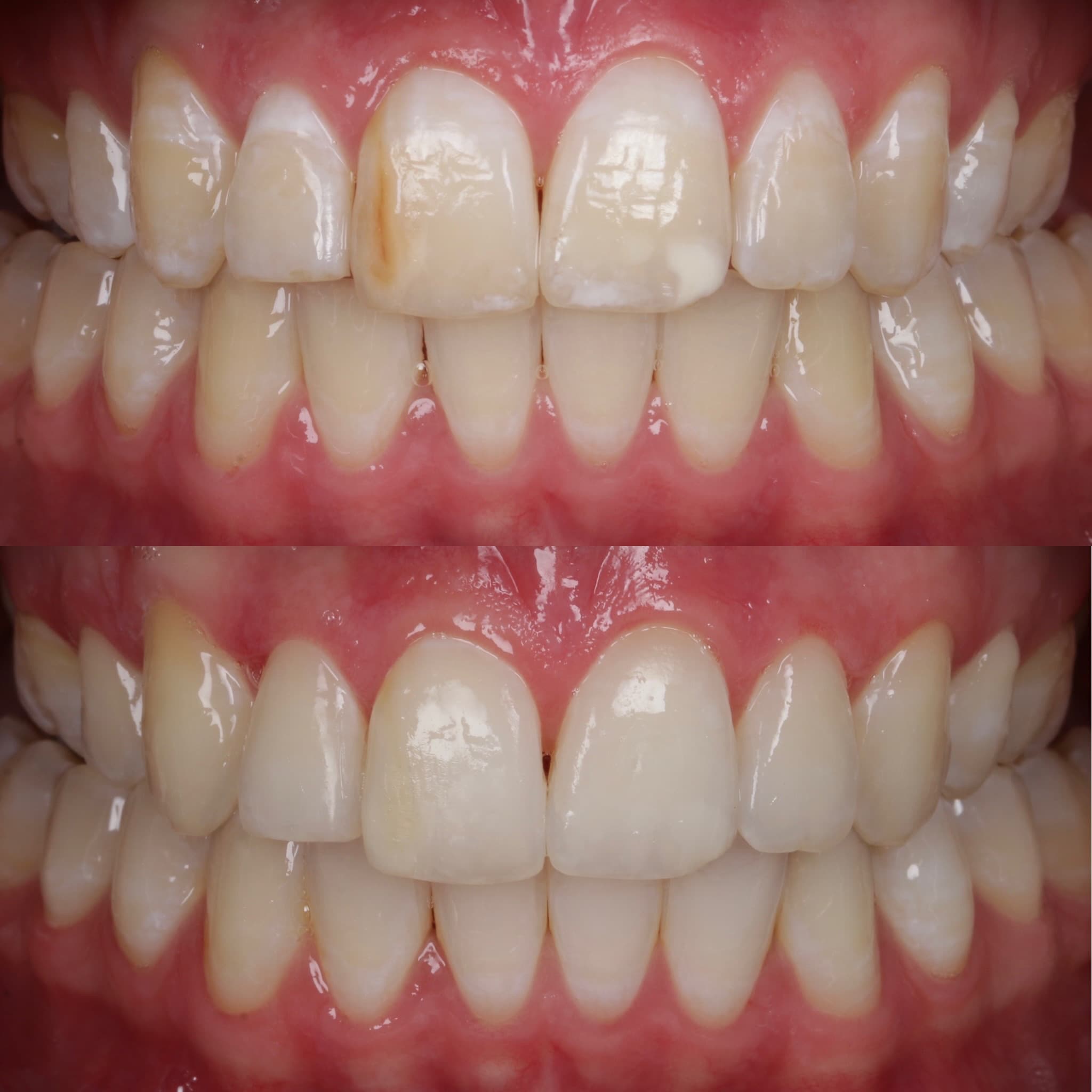 ICON Treatment treatment