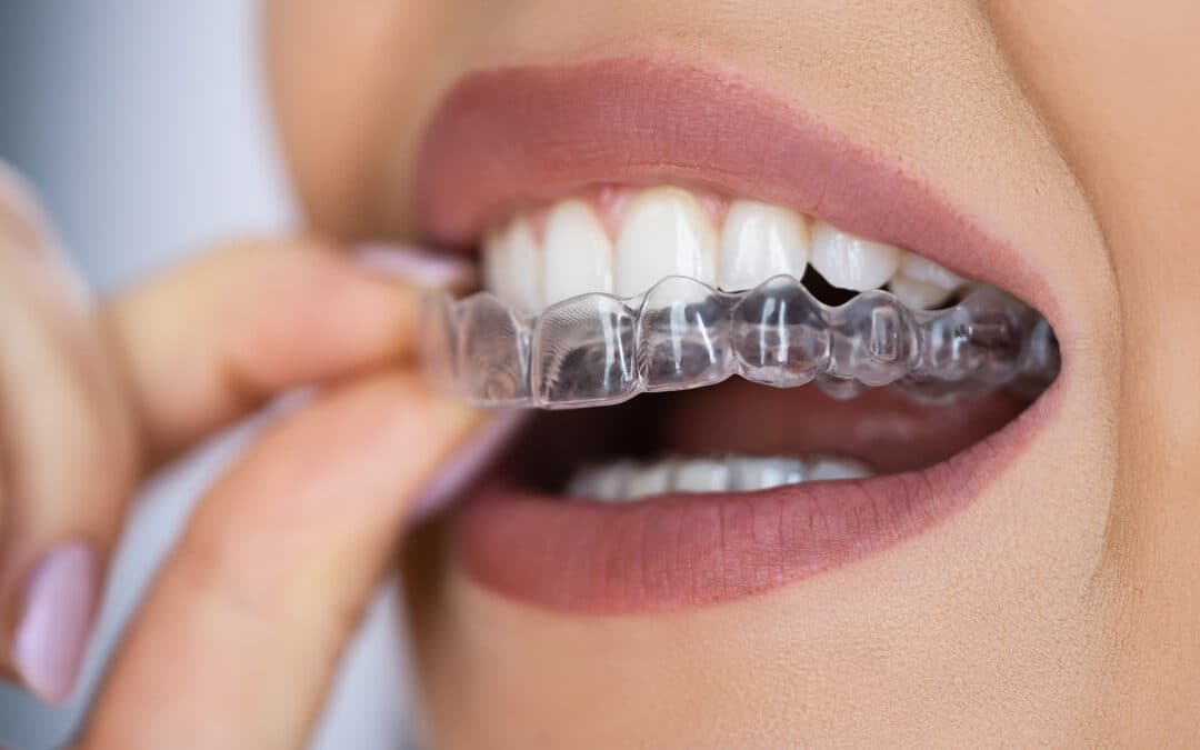 Aligners treatment